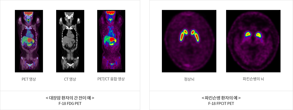 대장암 환자의 간 전이 예(f-18 fdg pet) : pef영상 사진, ct영상 사진, pet/ct 융합 영상 사진 / 파킨슨병 환자의 예(f-18 fpcit pet) : 정상뇌 사진, 파킨슨병의 뇌 사진