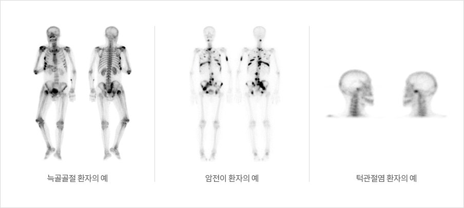 늑골골절 환자의 예 사진, 암전이 환자의 예 사진, 턱관절염 환자의 예 사진