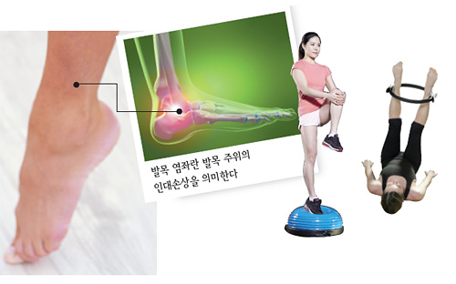 발목염좌