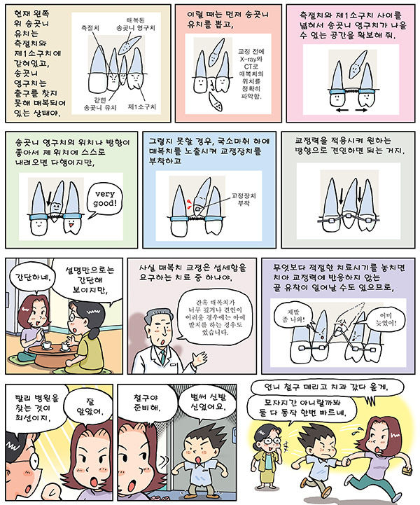 매복치 교정
